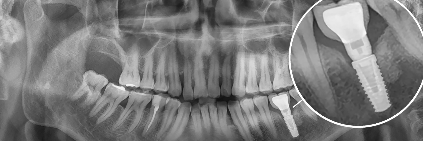 Dental Implants | Dentist
